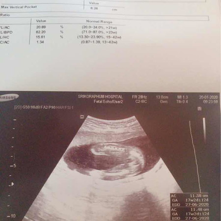 อัลตราซาวด์