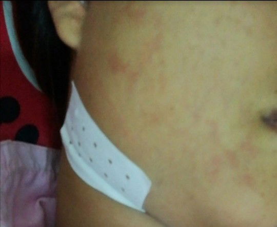 โรคเหงือกบวม+อักเสบ