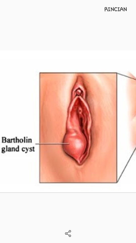 keputihan di sertai benjolan