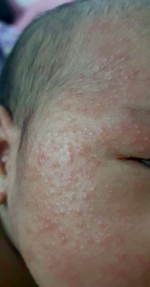 baby rashes!