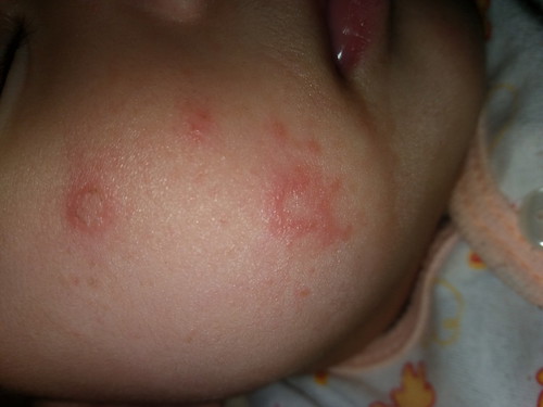 ผื่นอะไร