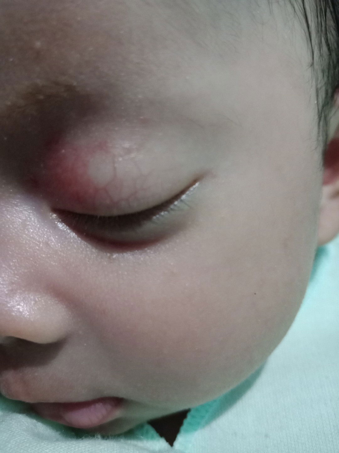 kelopak mata bayi merah