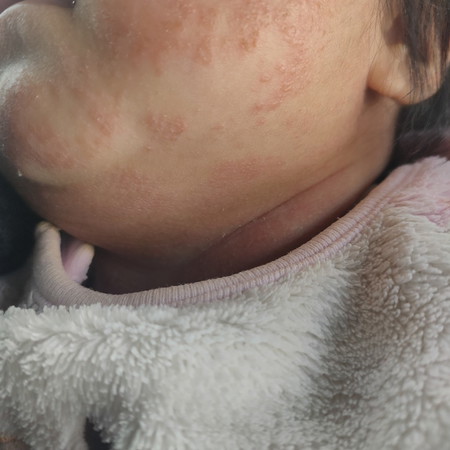 Rashes