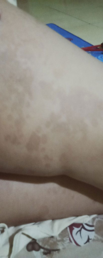 bercak hitam di paha