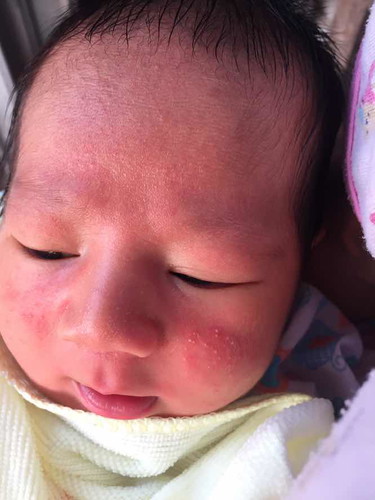 เด็กแรกเกิด ได้6วัน ตุ่มขาวๆเหลืองขึ้นน่า