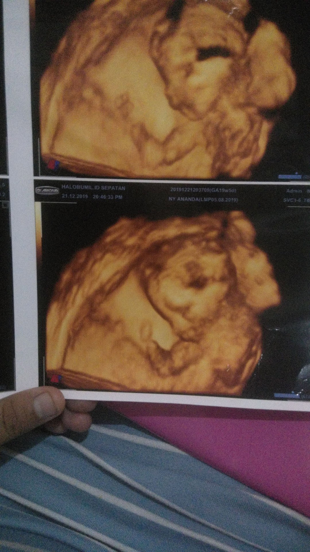 usg 20 weeks