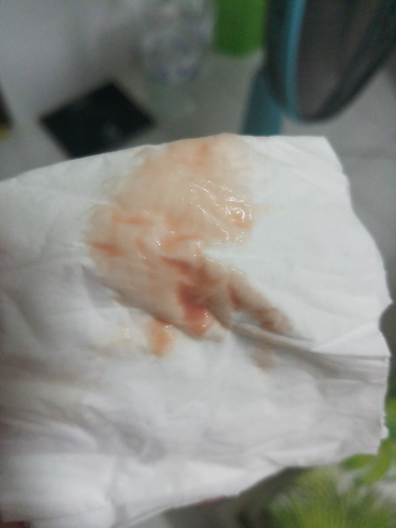 ภาวะแท้งคุกคาม