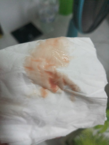 ภาวะแท้งคุกคาม