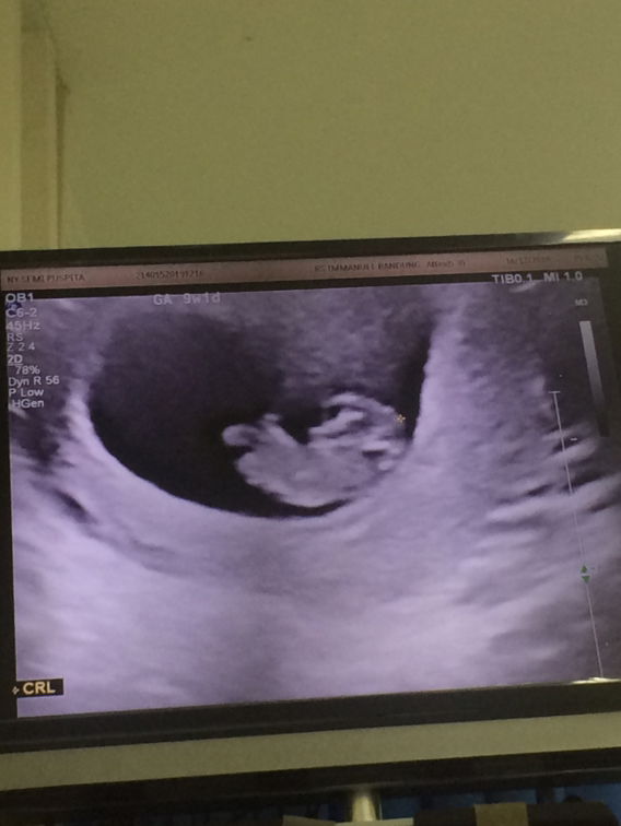 Assalamualaikum, Bunda Sharing dong.  Kemarin Saya Habis Kontrol usia kandungan 9w1d. Alhamdulillah Sudah Semakin Tumbuh kata dokter di jelasin ini kepala, ini tubuh dan kaki.