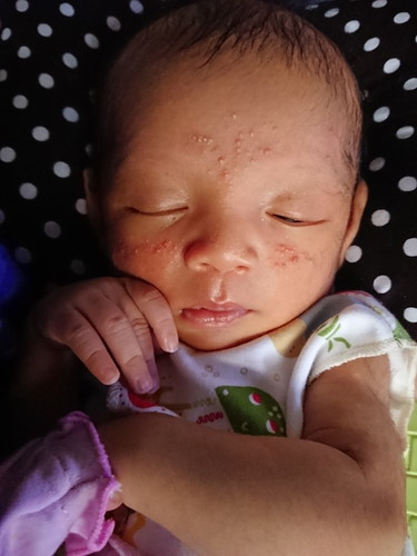 jerawat bayi