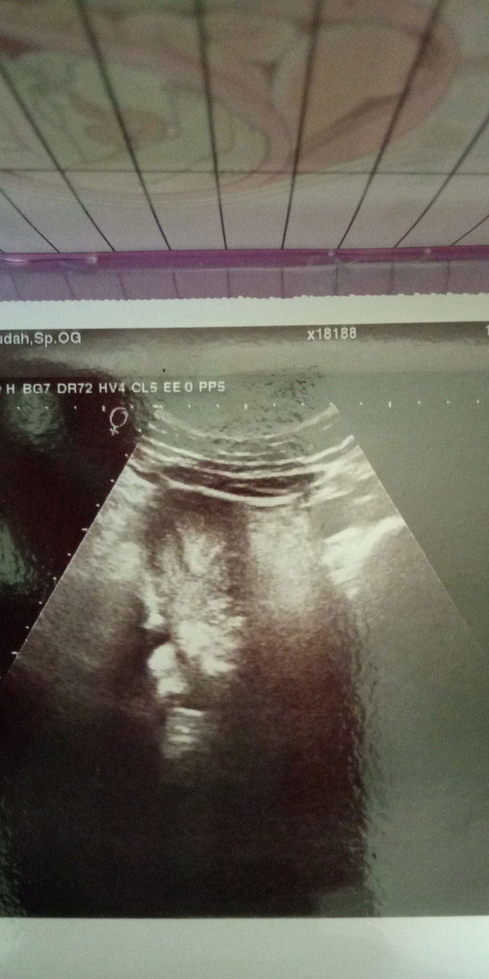 USG Kehamilan Pertama