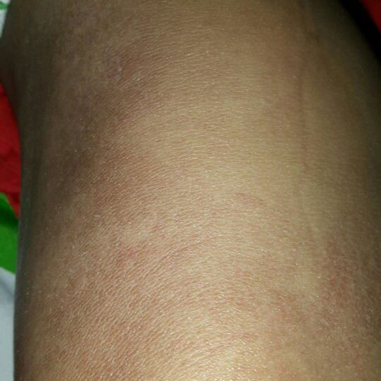 kulit memerah coklat dan gatal..