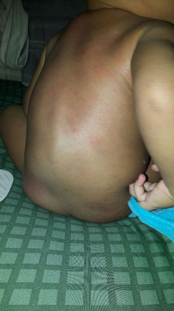 badan merah dan tulang bengkok