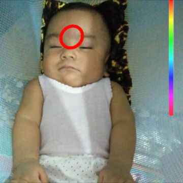 penyempitan pembuluh darah?