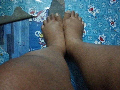 ขาบวม