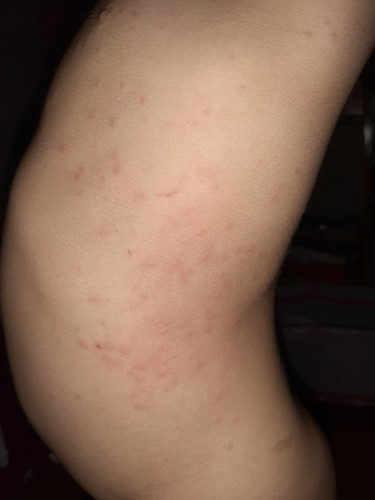 TYPHOID CYST VACCINE