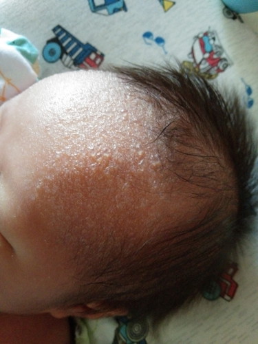 ผื่นร้อน...รึว่าแม่ทำให้เป็นแบบนี้