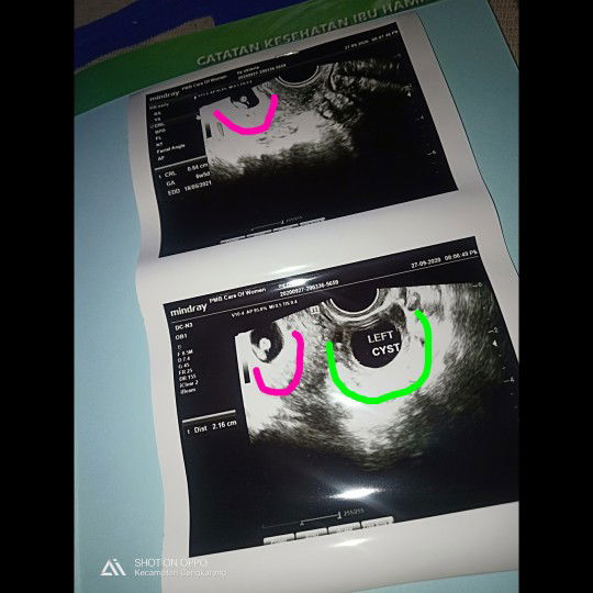 HasilL USG Transvaginal