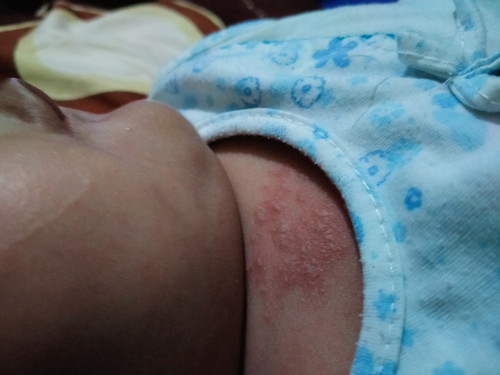 merah2 pada kulit bayi