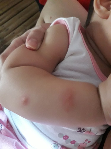 Insect bite
