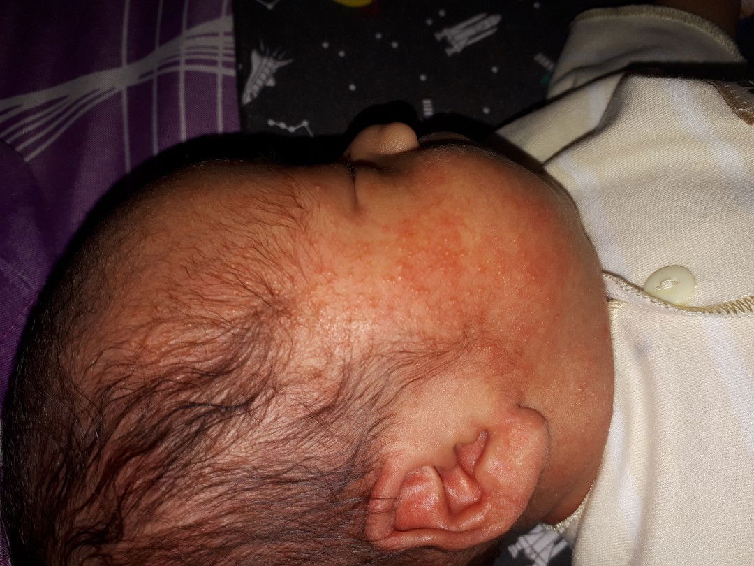 bintik merah pada bayi