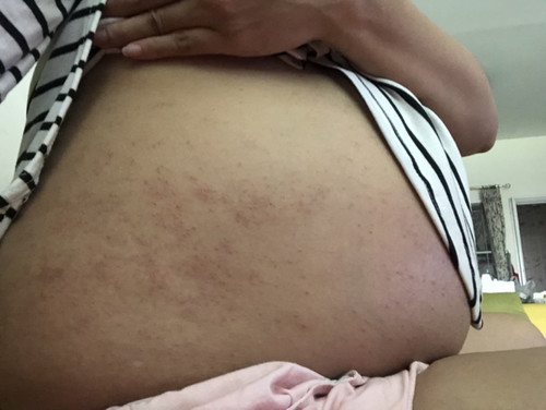 สอบถามคะ ท้อง6 เดือน ท้องขึ้นผื่นแดง แล้วคันมากเลยคะ ใครเป็นบ้างคะ แล้วมันจะเป็นอะไรถึงลูกไหมคะ ตอนนี้เริ่มคิดมากแล้วคะ