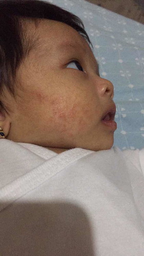 Baby acne