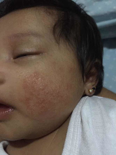 Baby acne or not