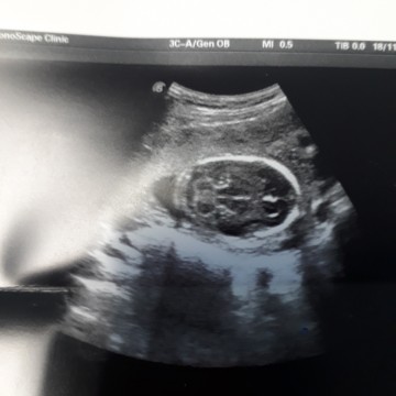 ตอนนี้ได้ 27 วีคแล้วค่ะ ลูกคนที่สอง ลูกคนแรกของเราแข็งแรงสมบูรณ์ดี ร่างกายปกติ