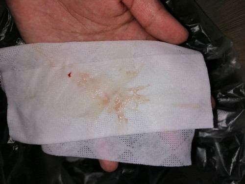 Implantation Bleeding Or Start Of Period?