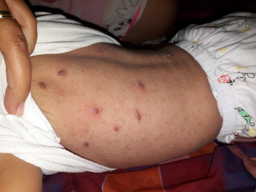 scabies