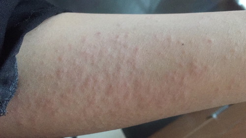 Kulit keluar Bintik2