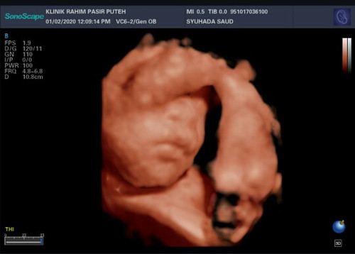 scan baby