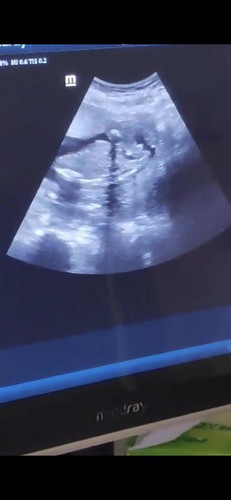 Boy or girl based on ultrasound