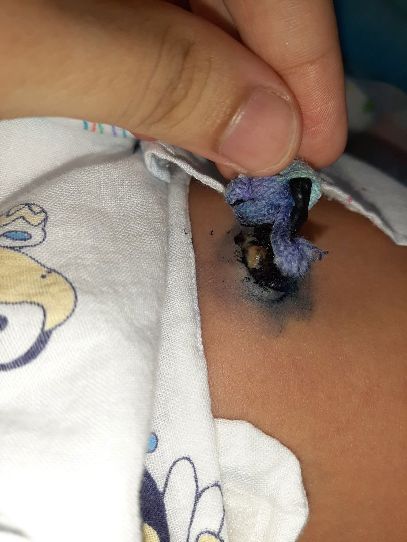 สะดือใกล้หลุด แบบนี้ติดเชื้อหรือปกติคะ