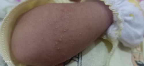 Bintik kayak bisul