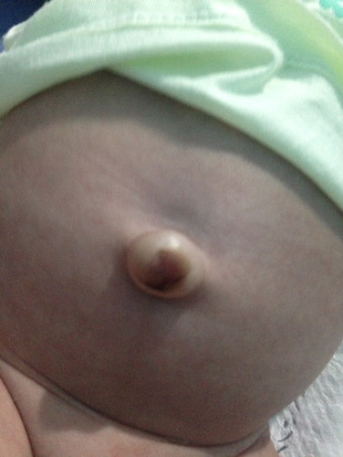 Umbilical Hernia