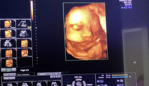 เพิ่งเป็นคุณแม่เลี้ยงเดี่ยวหมาดๆ เลยค่ะ ตอนนี้ท้องได้ 35 weeks แล้ว