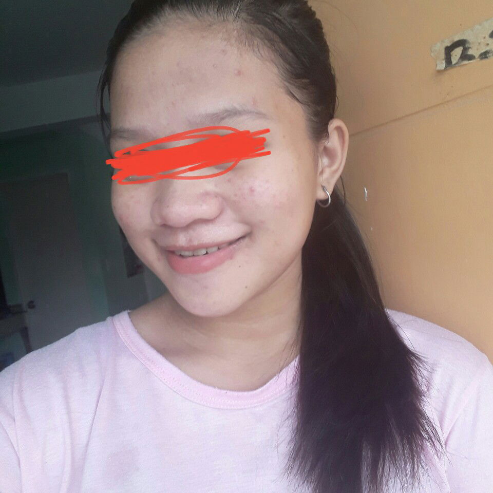 pimples.?