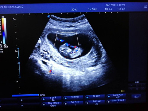 10wk แล้วค่ะ
