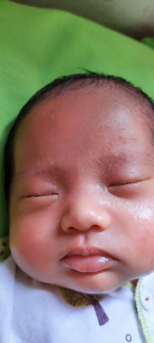 bintik bintik pada kulit wajah bayi