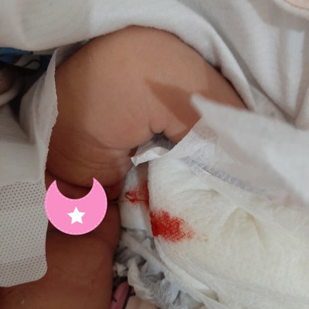 blood like mucus sa pepe ni baby girl 4days old
