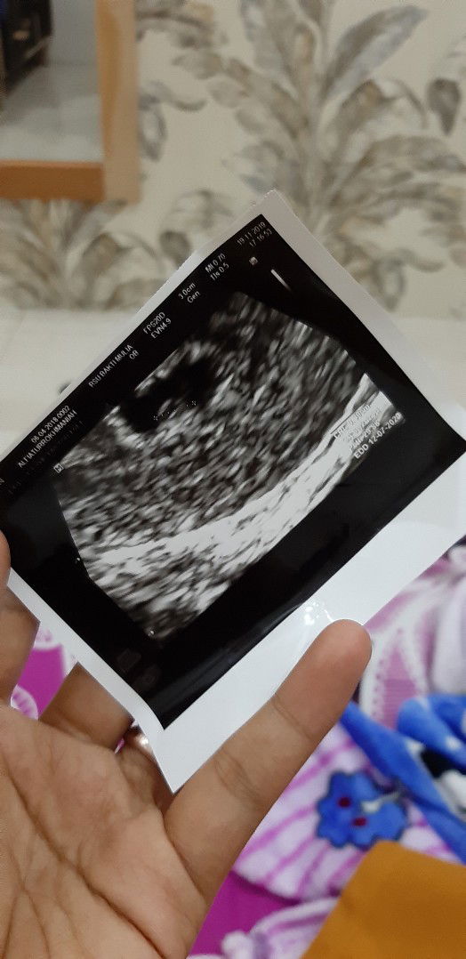 bayi tidak ada detak jantung