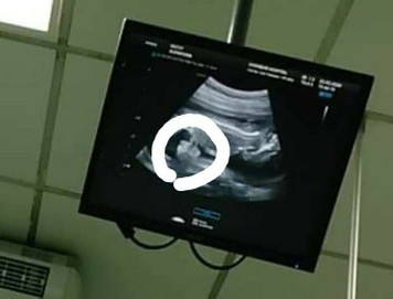 Gastroschisis