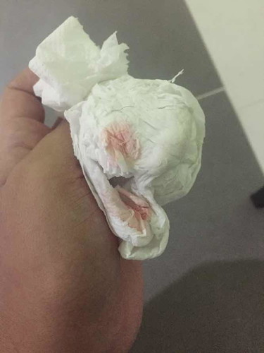 เลือดออก