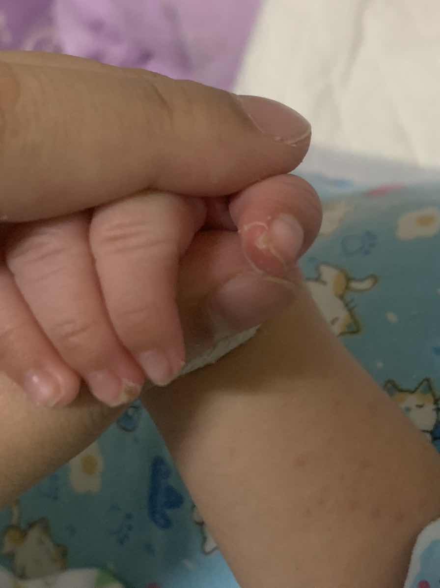 น้องเป็นเล็บขบรึป่าวคะ