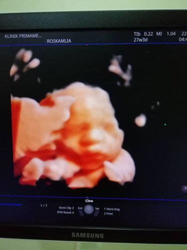 excited 1st baby after 5 years
