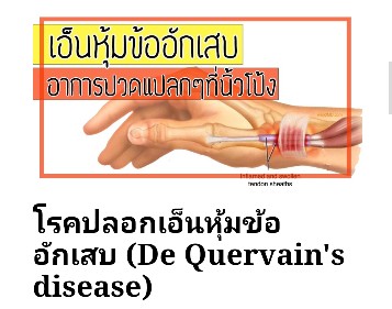 แม่บ้านไหนมีอาการปวดข้อมือแบบนี้บ้างค่ะ บ้านนี้ทรมานสุดๆ