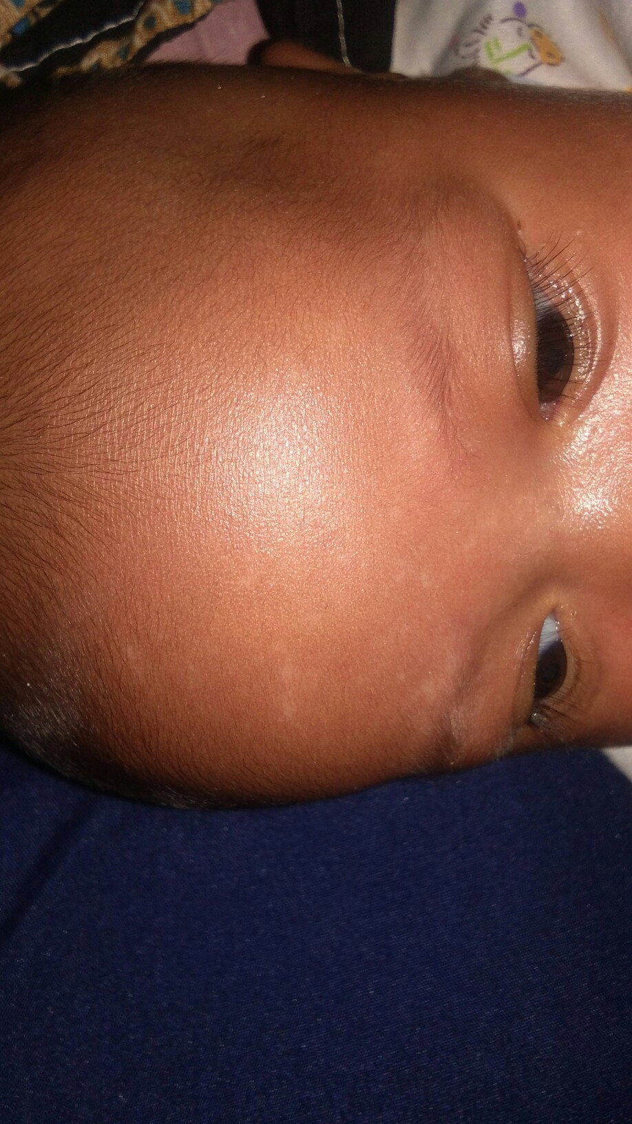 bercak putih pd wajah