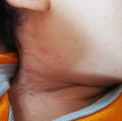 Baby Rash